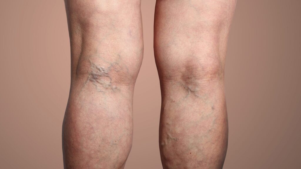Your Guide to Effective Varicose Vein Treatment