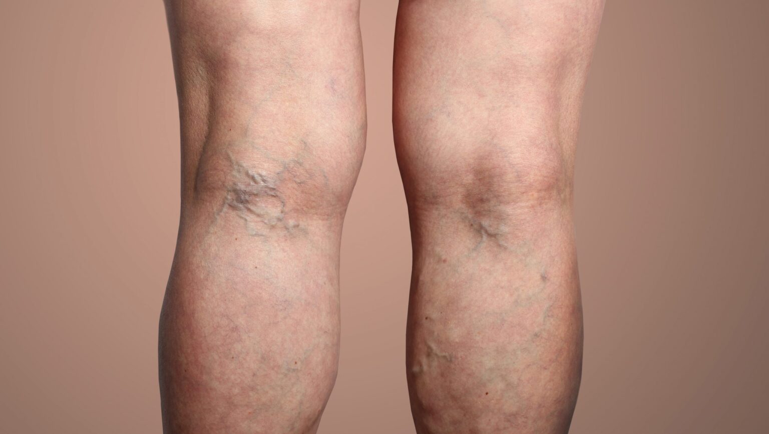 Your Guide to Effective Varicose Vein Treatment