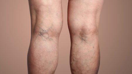 Your Guide to Effective Varicose Vein Treatment